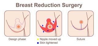Breast Reduction Surgery Types