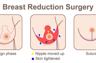 Breast Reduction Surgery Types