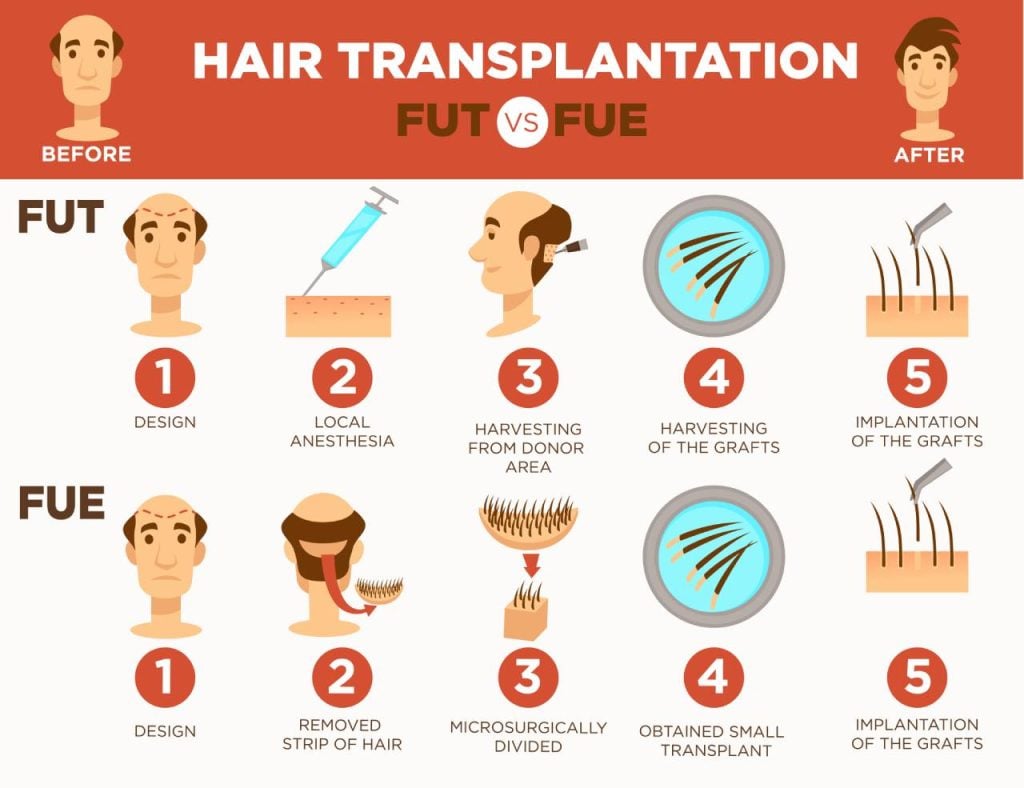Comparing FUE and FUT