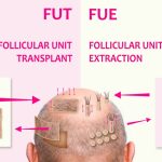 FUE vs. FUT: Which Hair Transplant Method is Better?