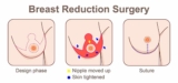 Facts & Facets Before Considering the Right Type of Breast Reduction Surgery