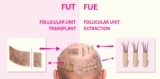 FUE vs. FUT: Which Hair Transplant Method is Better?