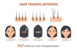 FUT Hair Transplants Explained: Benefits, Procedure, and Recovery Tips