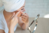 Hormonal Chin Acne: Treatment Options That Work